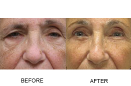 Dr. Schiller's Signature Surgery