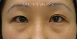 Patient # 20257 Before Photo # 1