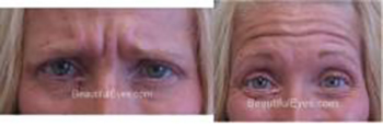 Patient # 82086 Before Photo # 1